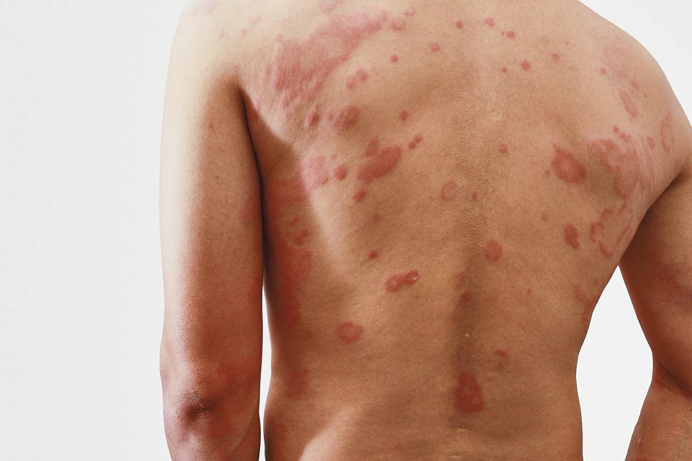 Kdy se projevy alergie na antibiotika?